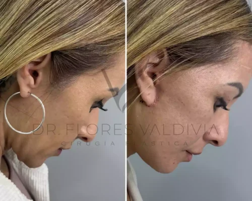 Side-by-side profile photos of a woman before and after a cosmetic procedure, showing a noticeable reduction in her double chin.